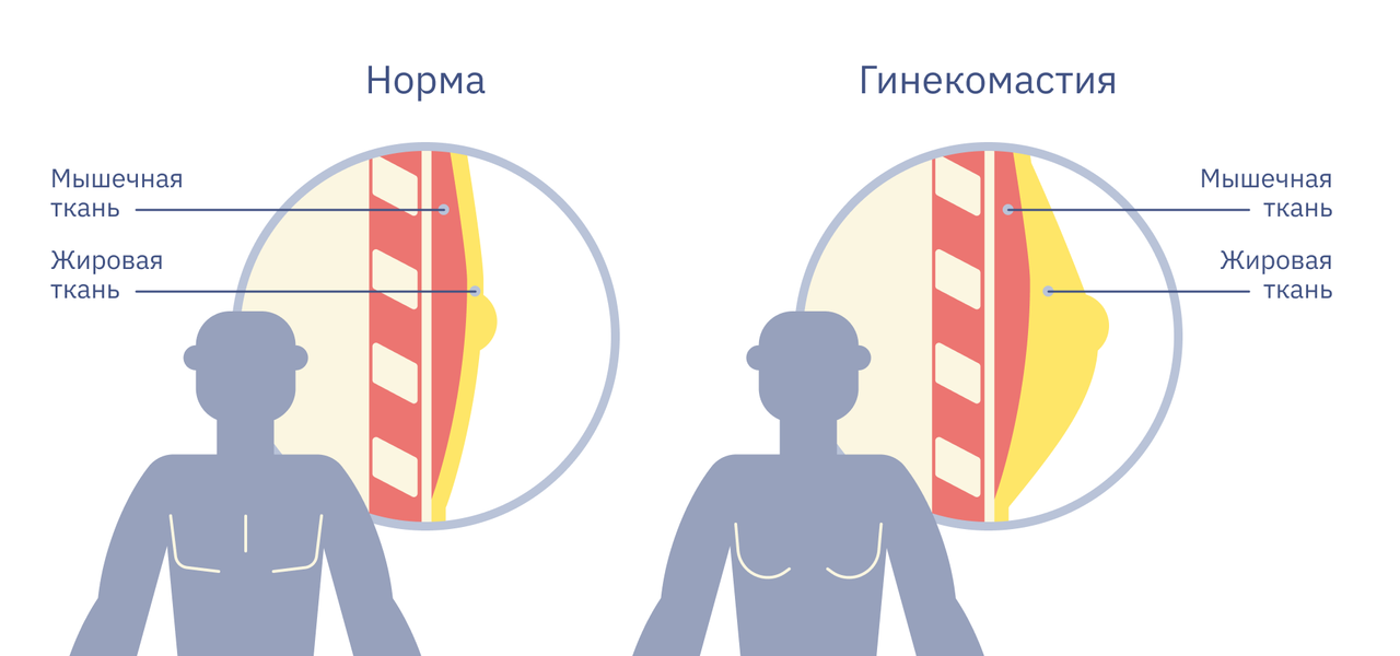 Выделение из груди у подростка. Жировой некроз молочной железы фото.