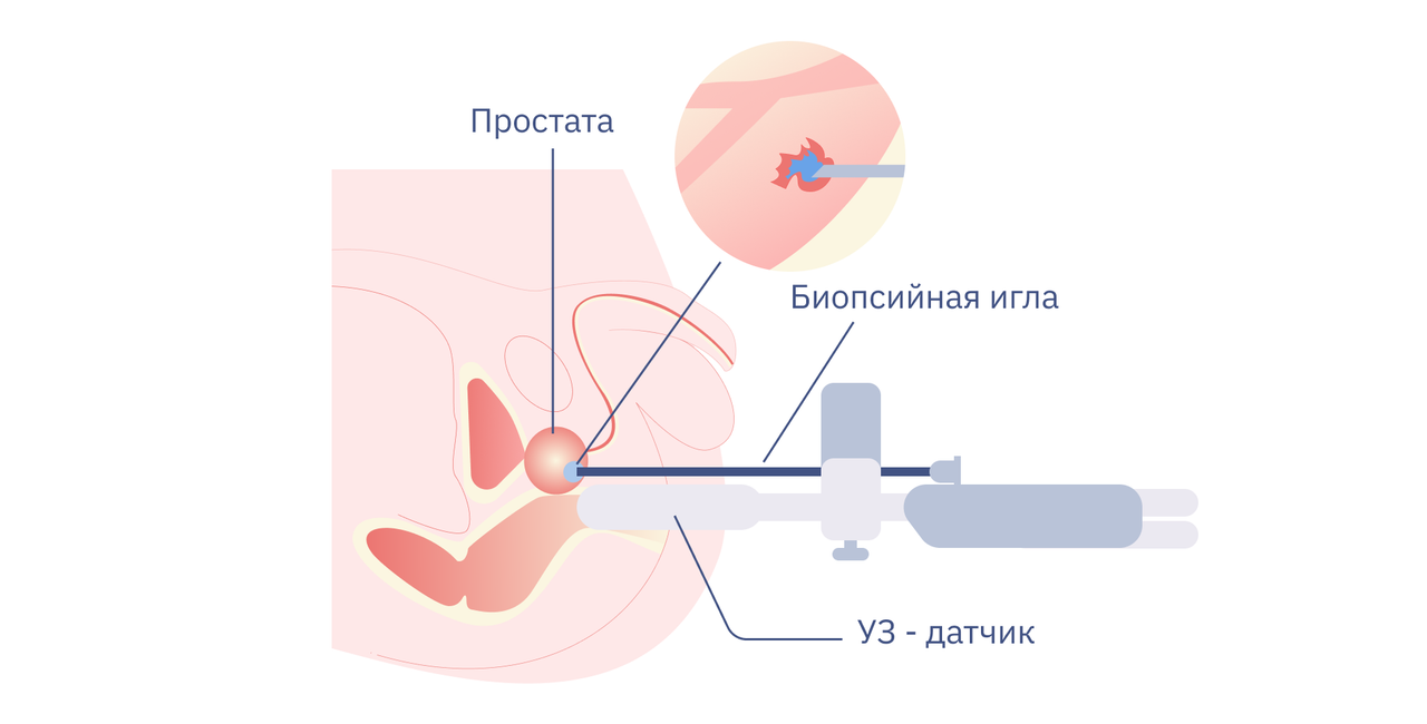 Как проходит fusion-биопсия? 