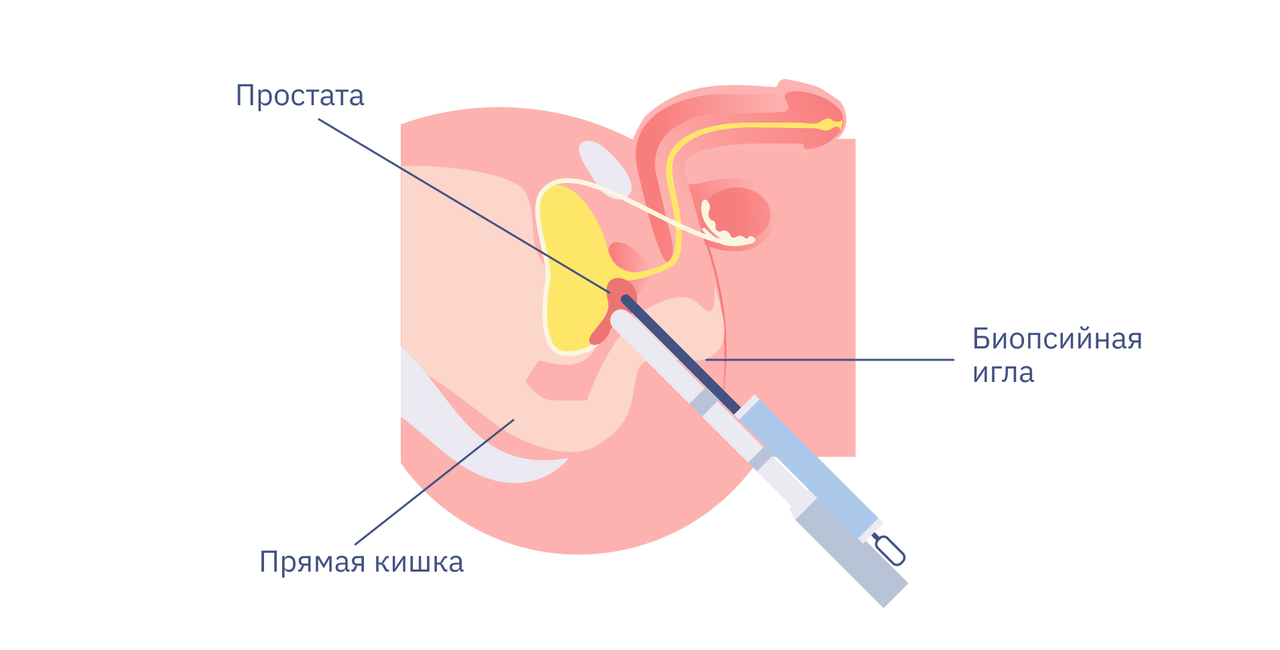 Как проходит fusion-биопсия? 