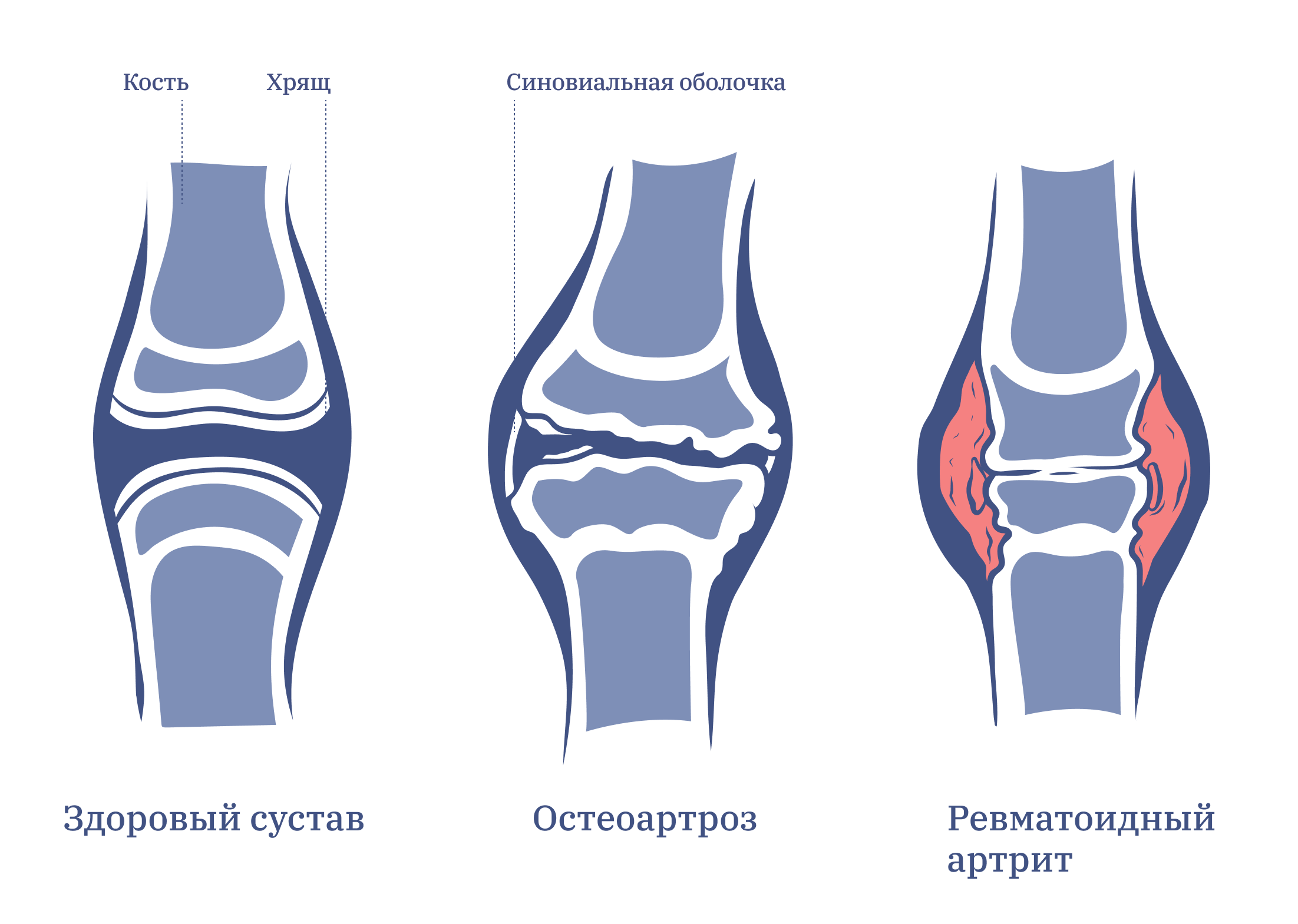 Деформация коленного сустава. Коленный хрящ поврежден.