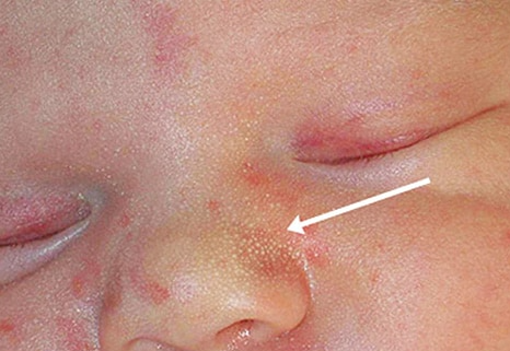 Прыщи на лице: основные причины появления и лечение