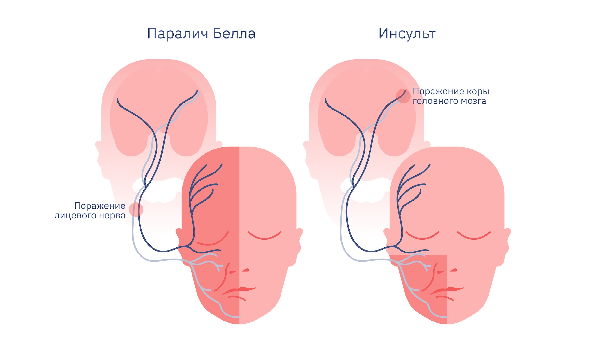 Неврит лицевого нерва код по мкб 10. Сглаженность носогубной складки. Сглаженность носогубной складки синдром. Сглаженность носогубной складки при инсульте. Лицевой нерв.